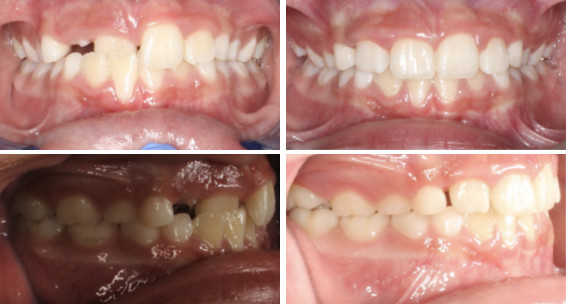 Simple anterior x-bite