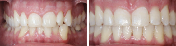 Invisalign Crowding