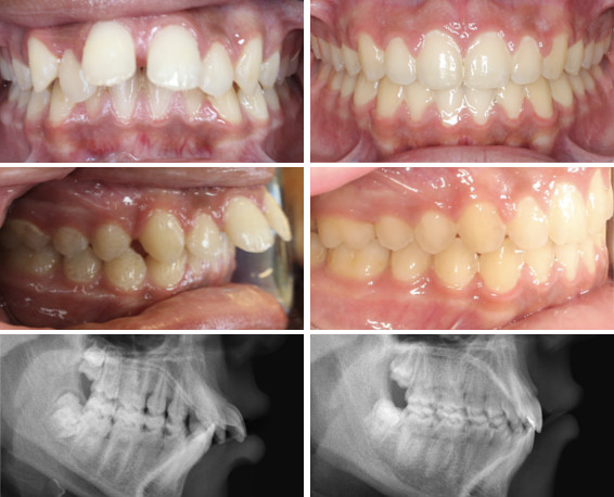 Overbite